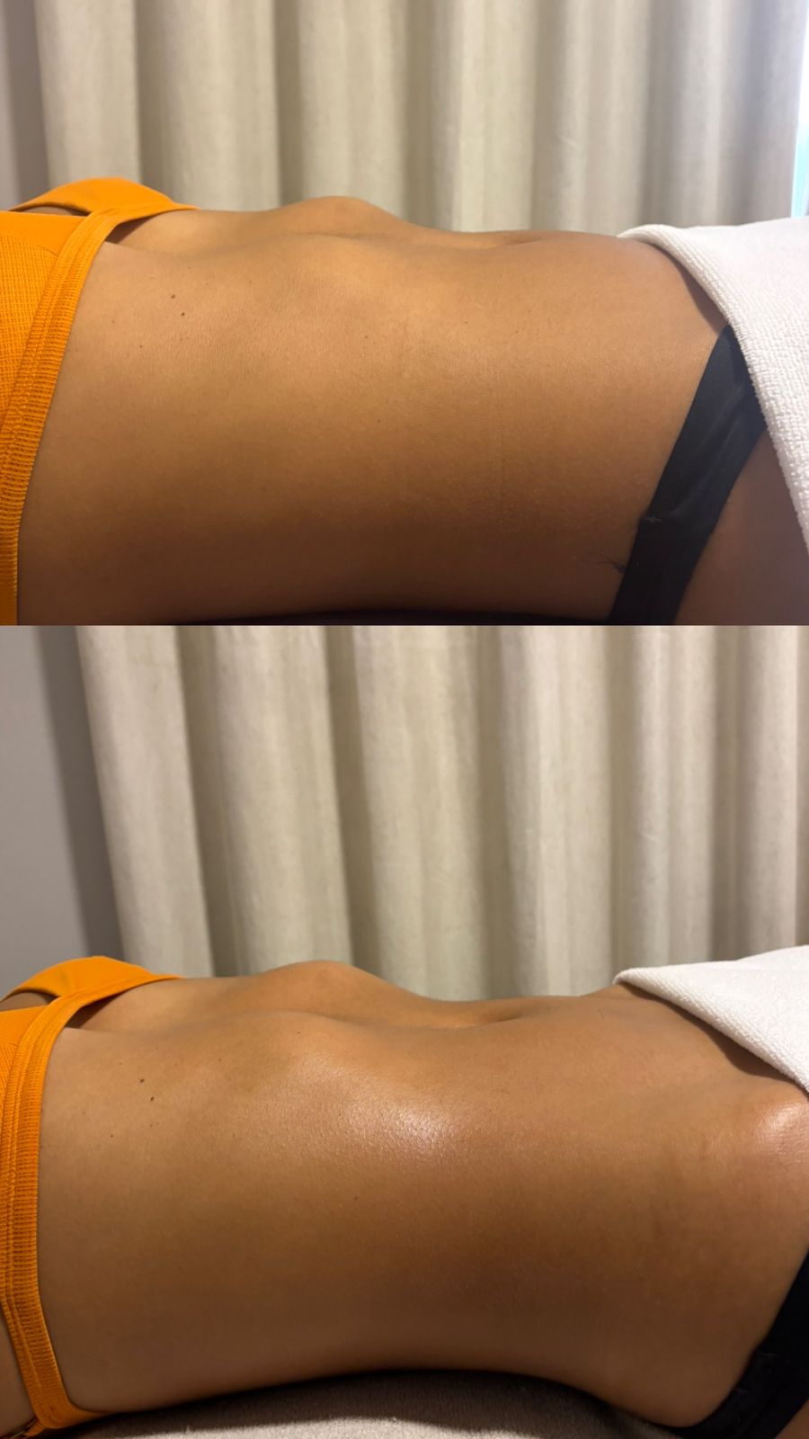 Resultado abdômen lateral — antes e depois