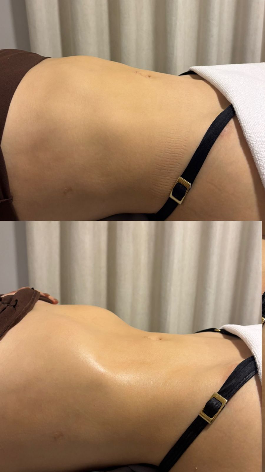 Resultado lombar — antes e depois