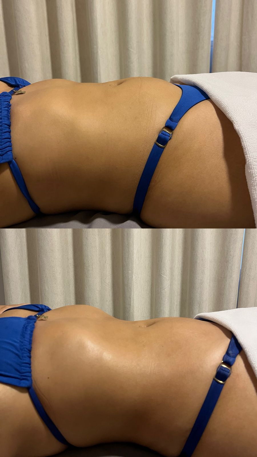 Resultado lombar e flancos — antes e depois